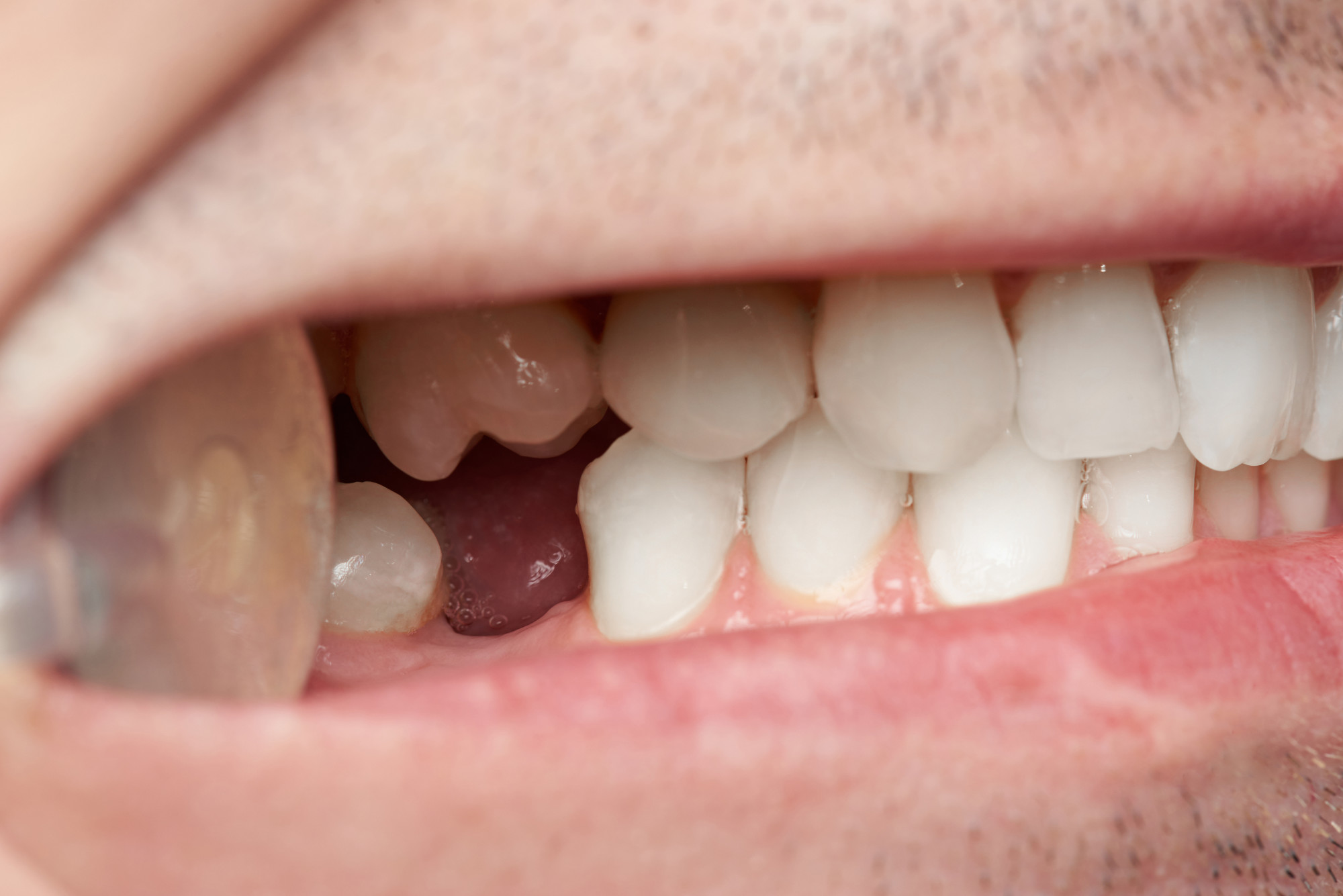 Accidents happen, and many adults lose teeth at some time or another due to a sports injury or mouth trauma. Here is what to do if you suddenly lose a tooth.