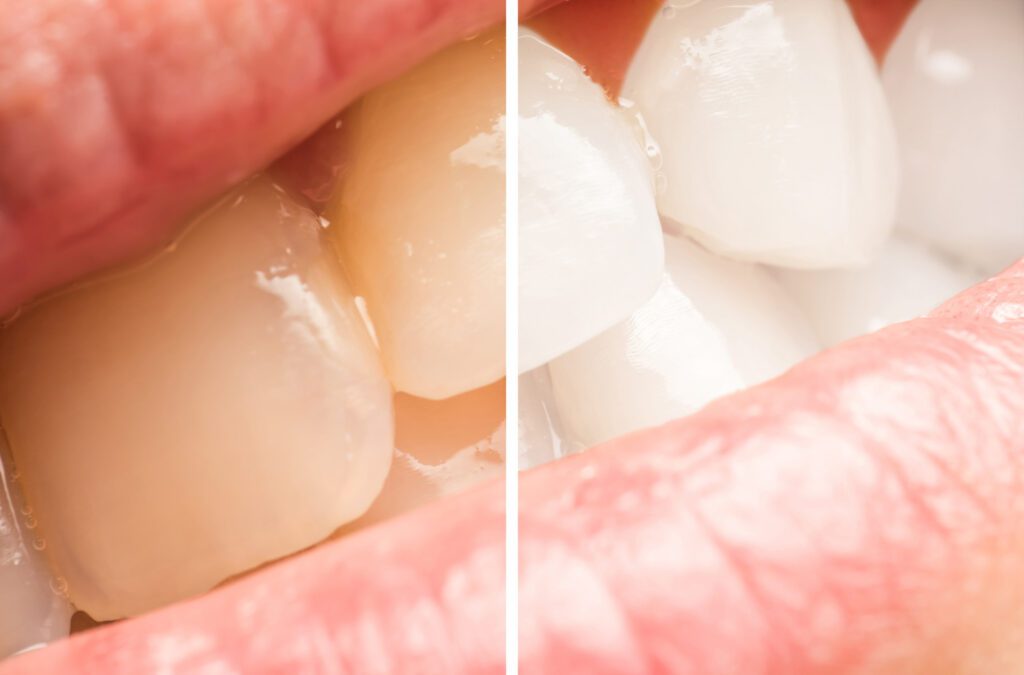 Teeth Whitening for Sensitive Teeth What You Need to Know Wake Up Roma!