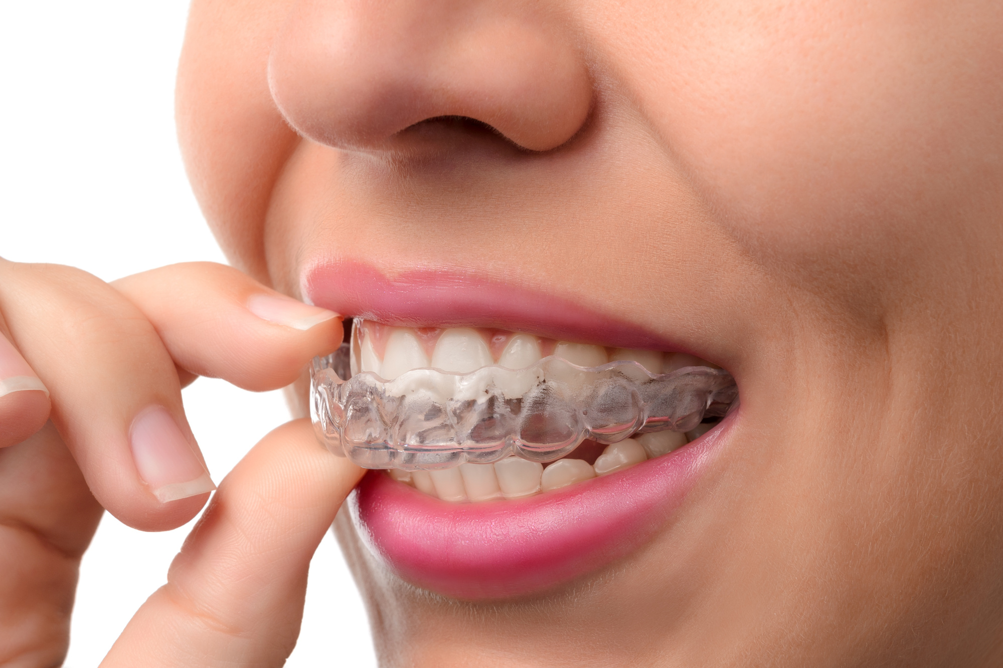 Before you get Invisalign, you should know the prices you can expect to pay. This guide covers the average cost of Invisalign.