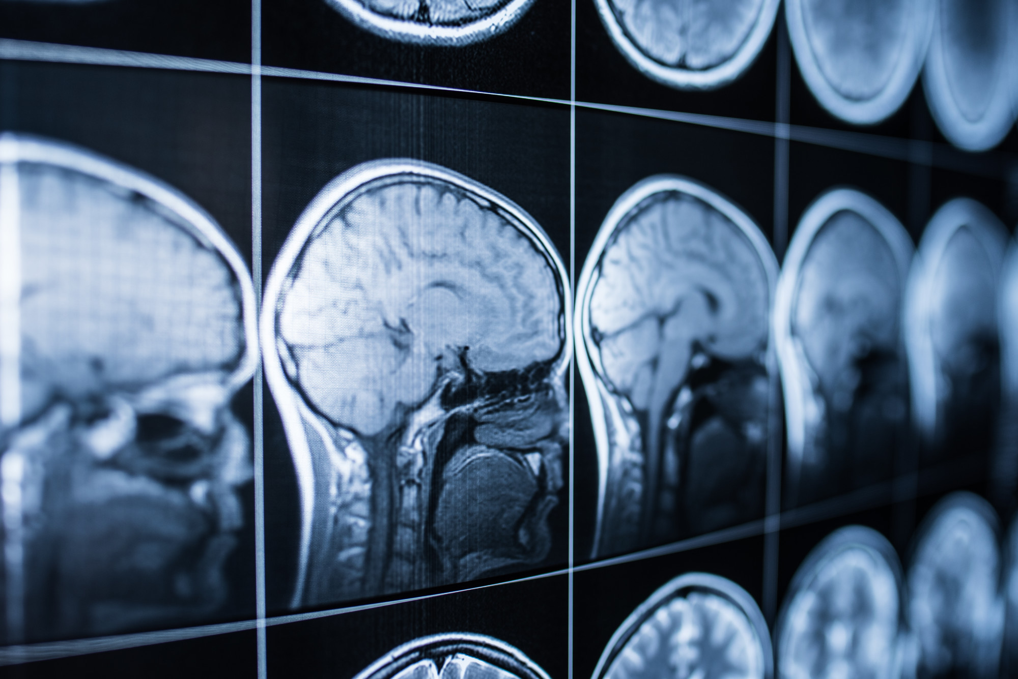 Do you think you may be suffering from a mild traumatic brain injury? Learn 5 signs that should be a cause for concern and a possible result of an mTBI.