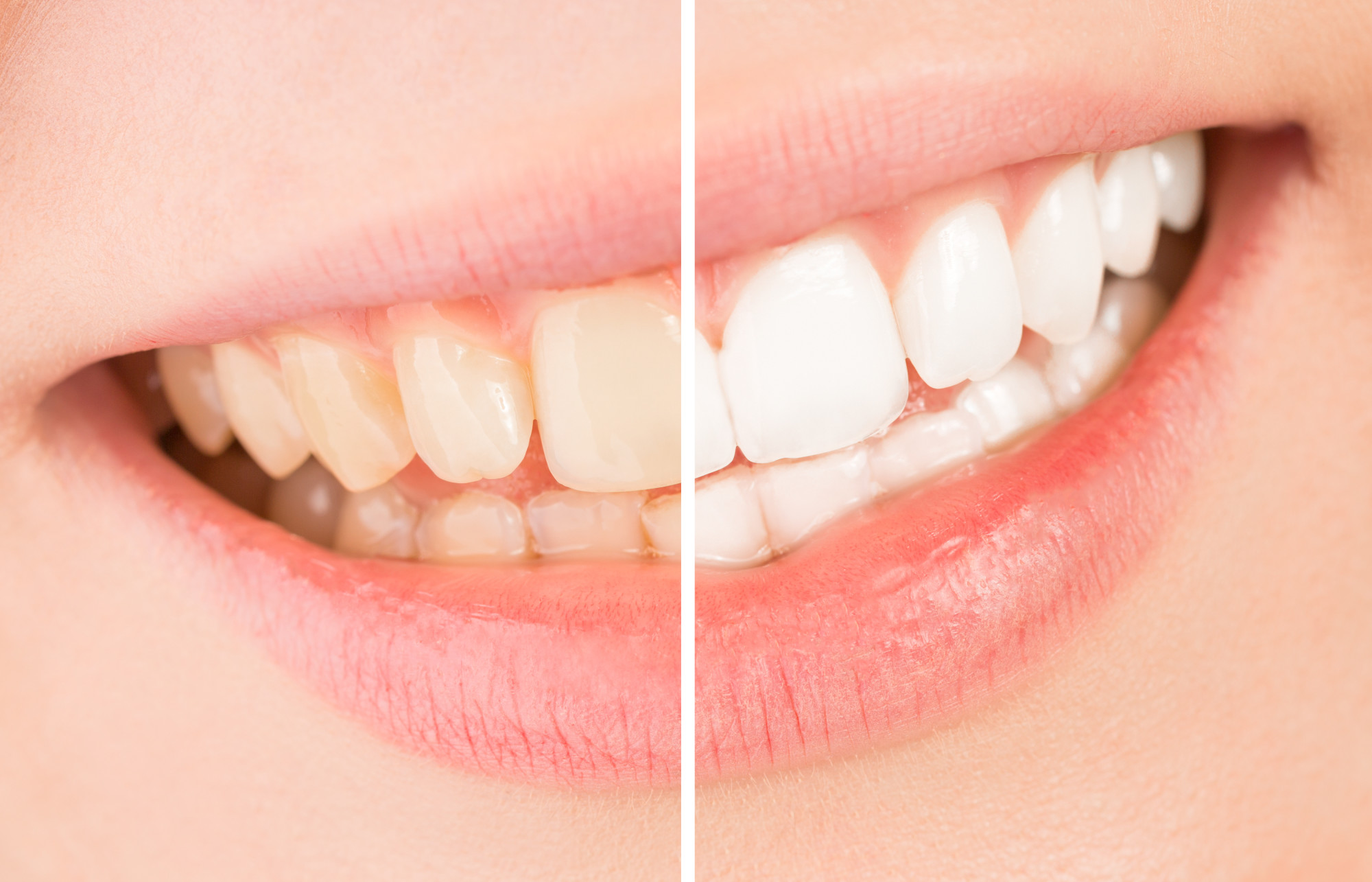 Are you considering getting your teeth whitened and wondering what the best treatment is? See our guide about the benefits of professional teeth whitening.